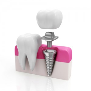 'dental implants'