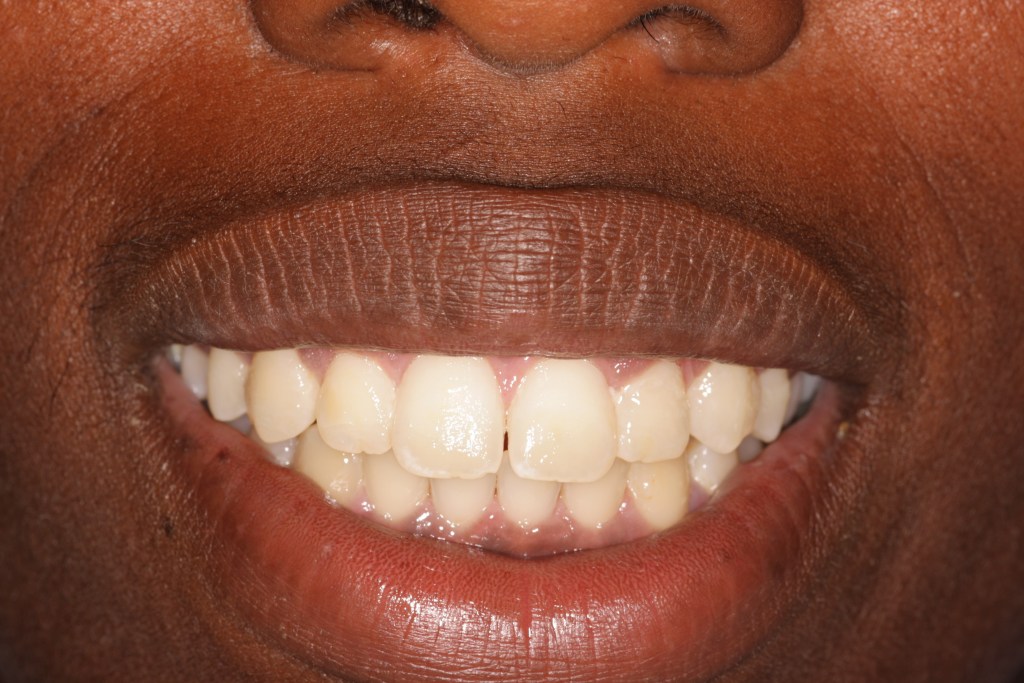 Before Gummy smile surgery performed by Dr. Barabas