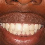 Before Gummy smile surgery performed by Dr. Barabas