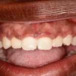 After Gummy smile surgery performed by Dr. Barabas