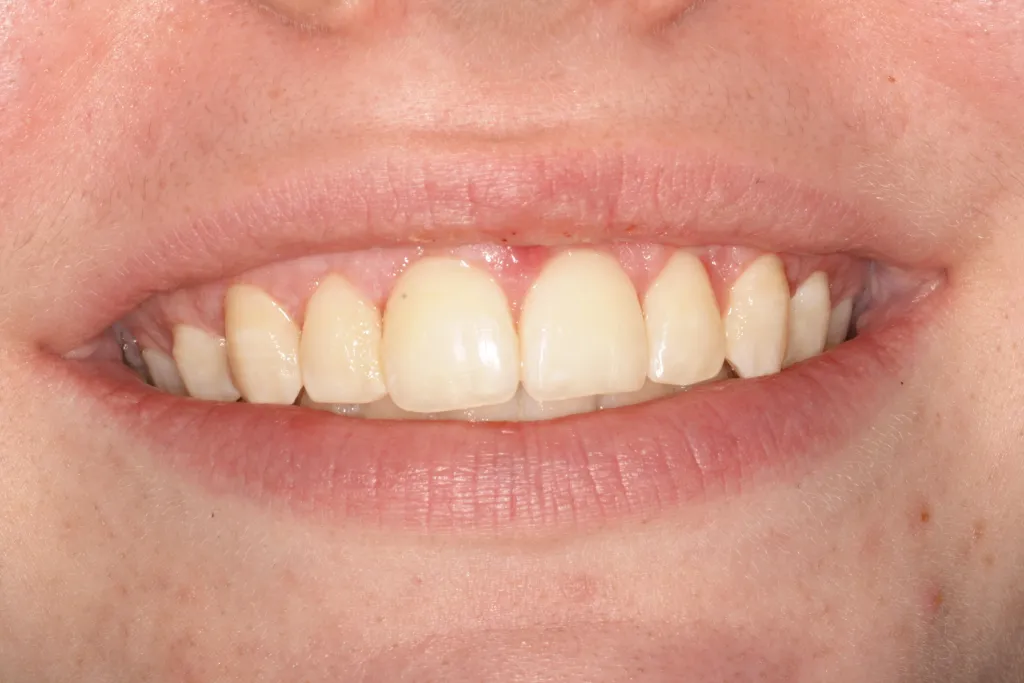 Before treatment to correct a gummy smile by Dr. Barabas