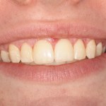 Before treatment to correct a gummy smile by Dr. Barabas