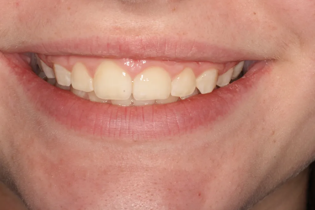 After treatment to correct a gummy smile by Dr. Barabas