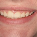 After treatment to correct a gummy smile by Dr. Barabas