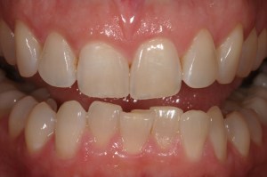 After Dental Implant Treatment