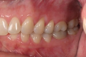 A mouth after a Dental Implant Treatment