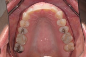An open mouth showing after Dental Implant Treatment