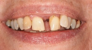Before performing Full-Arch Treatment