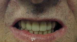 After Full Arch Treatment