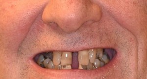 Before Full Arch Treatment