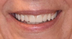 After performing Full-Arch Treatment