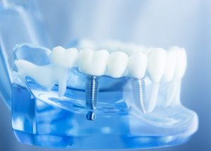 dental implants surgery bergen county nj