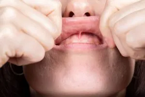 frenum therapy ridgewood nj