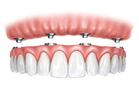 same day dental implants bergen county