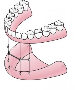 bar attachment dentures Bergen County NJ